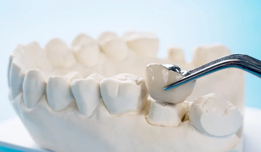 A ceramic crown being placed on a dental model with a dental instrument.