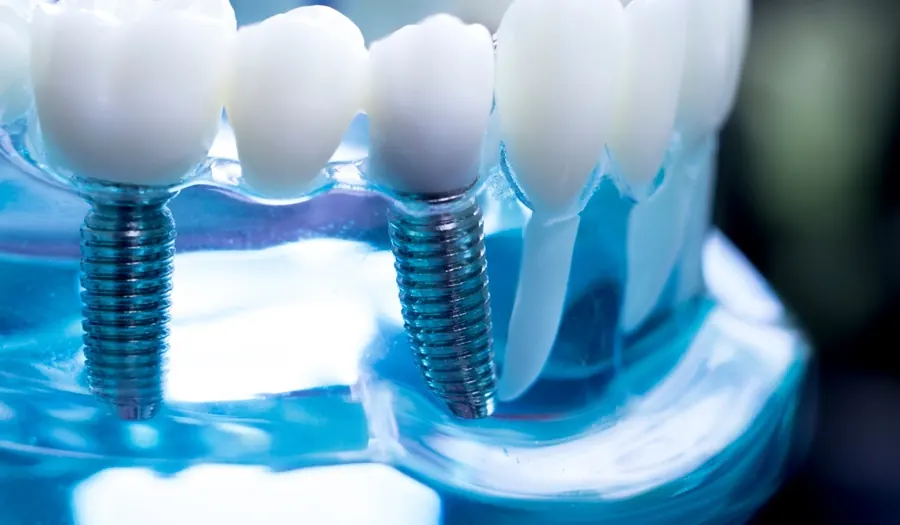A clear model of dental implants supporting a row of replacement teeth.