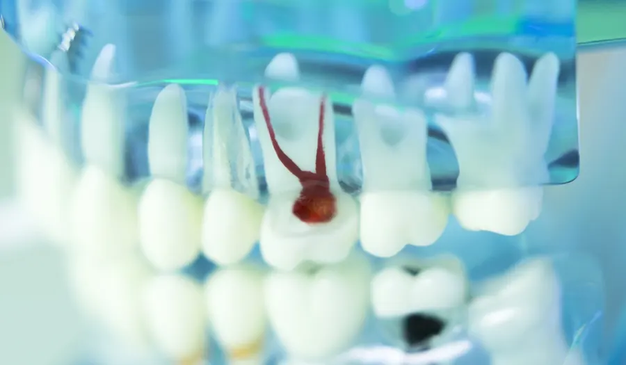 A clear dental model showing the root canal inside a tooth.
